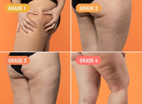 Check-up Cellulite